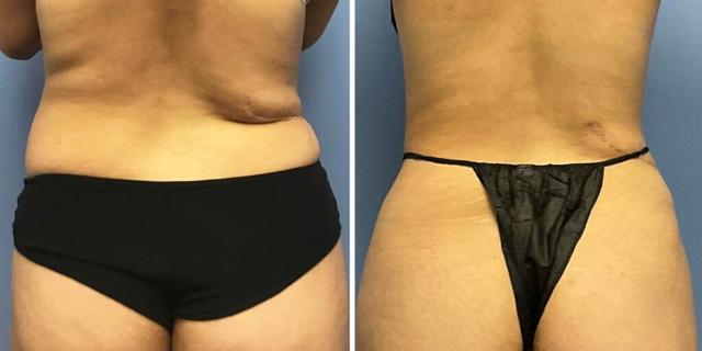 Liposuction result at Bluemont Plastic Surgery in Fairfax, VA