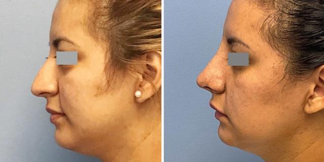 Rhinoplasty result at Bluemont Plastic Surgery in Fairfax, VA