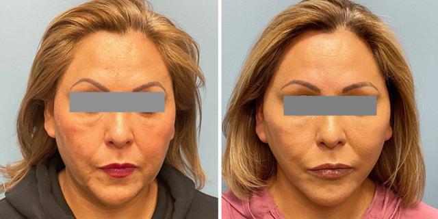 Facelift result at Bluemont Plastic Surgery in Fairfax, VA