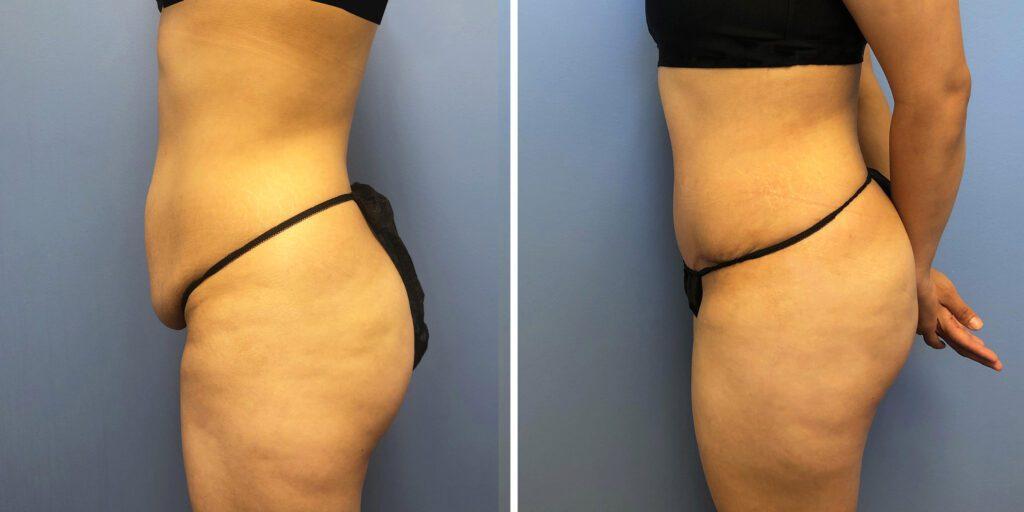 Bluemont Plastic Surgery tummy tuck result — Fairfax, VA
