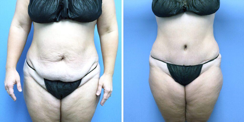 Bluemont Plastic Surgery tummy tuck result — Fairfax, VA