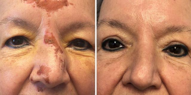 Blepharoplasty result at Bluemont Plastic Surgery in Fairfax, VA
