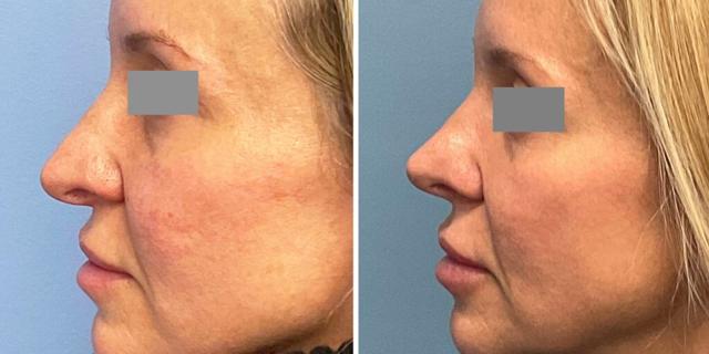 Ethnic Rhinoplasty result at Bluemont Plastic Surgery in Fairfax, VA
