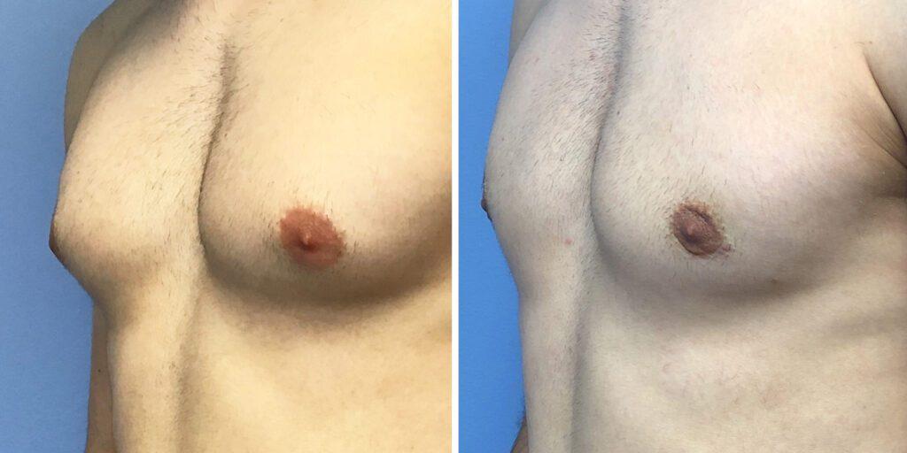 Bluemont Plastic Surgery result — Fairfax, VA
