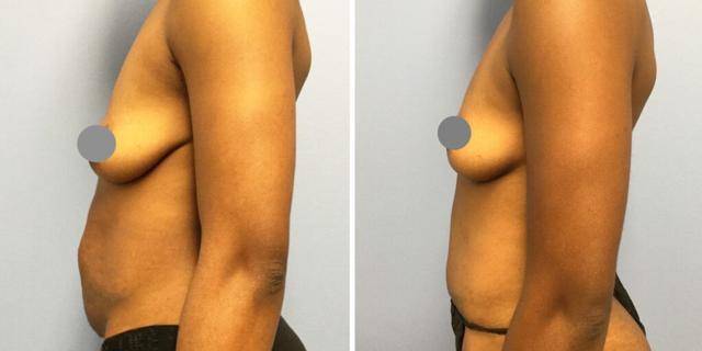 Mommy Makeover result at Bluemont Plastic Surgery in Fairfax, VA