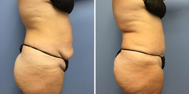 Tummy Tuck result at Bluemont Plastic Surgery in Fairfax, VA