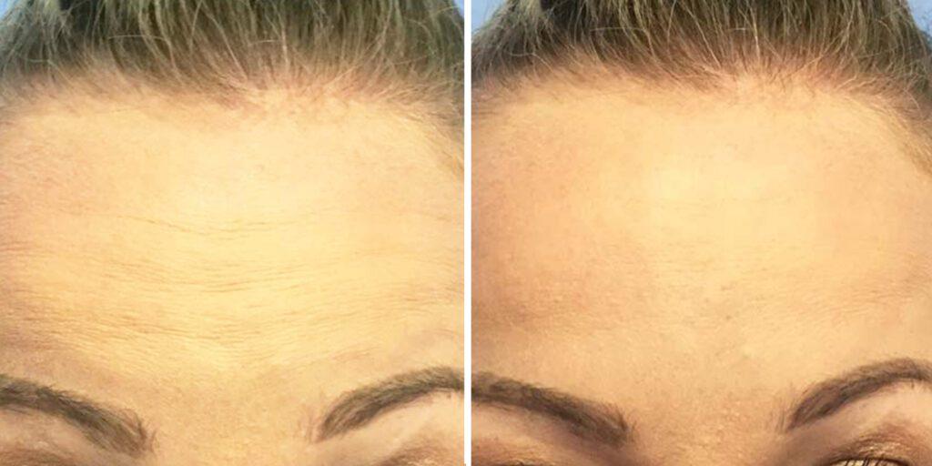 Bluemont Plastic Surgery result — Fairfax, VA