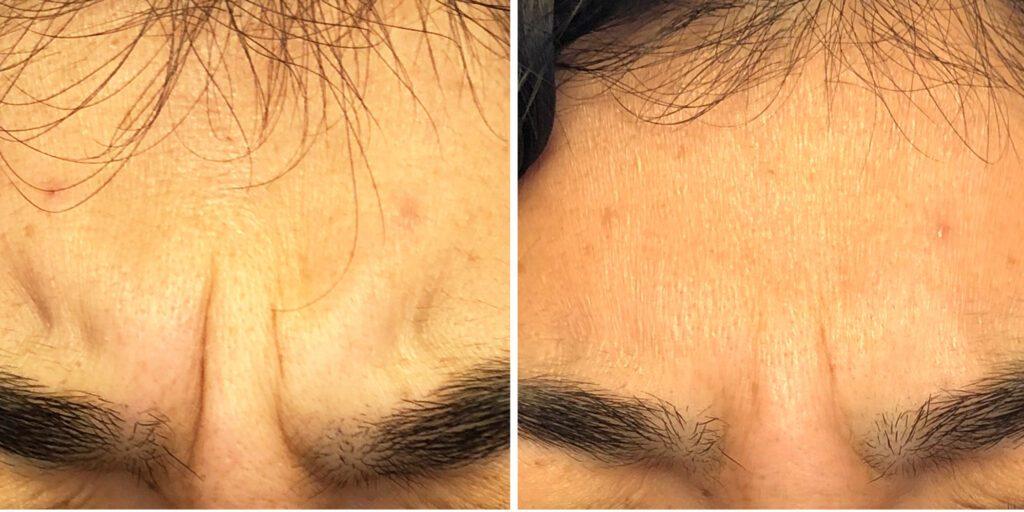 Bluemont Plastic Surgery result — Fairfax, VA