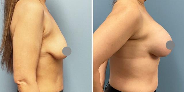 Breast Augmentation result at Bluemont Plastic Surgery in Fairfax, VA