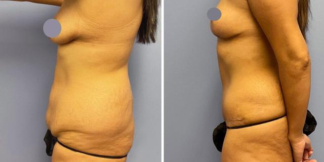 Mommy Makeover result at Bluemont Plastic Surgery in Fairfax, VA