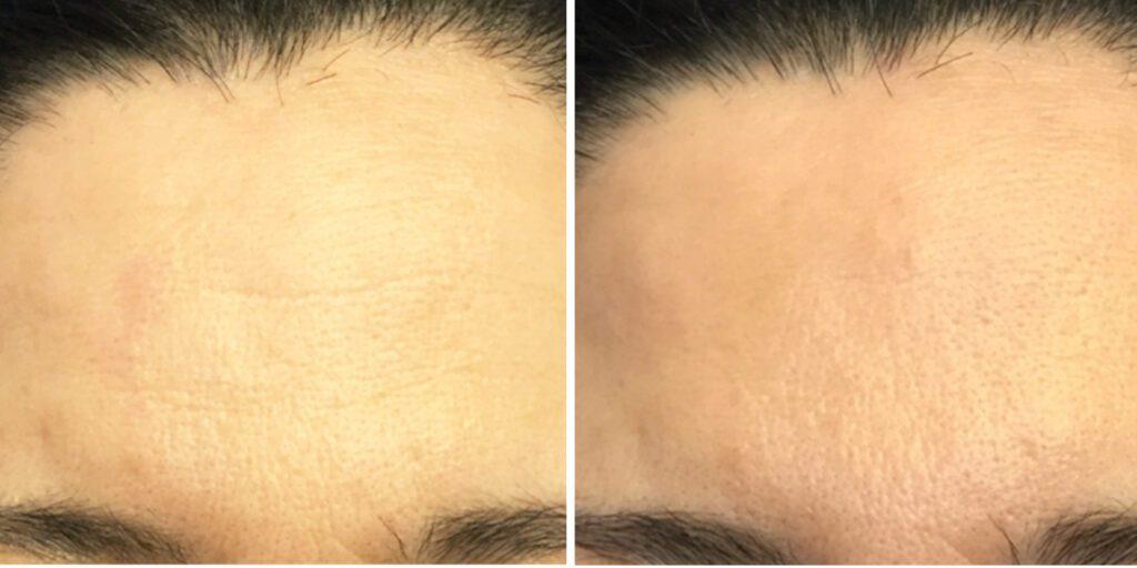 Bluemont Plastic Surgery result — Fairfax, VA