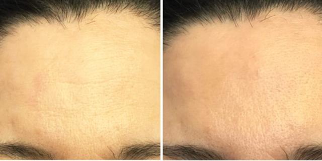 Botox result at Bluemont Plastic Surgery in Fairfax, VA