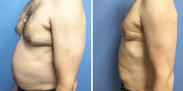 Gynecomastia Surgery result at Bluemont Plastic Surgery in Fairfax, VA