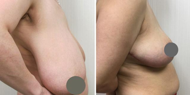 Breast Reduction result at Bluemont Plastic Surgery in Fairfax, VA