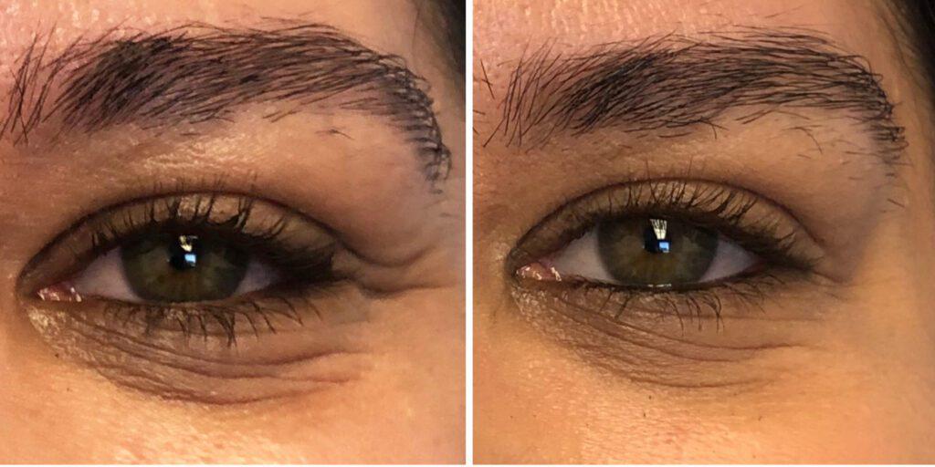 Bluemont Plastic Surgery result — Fairfax, VA