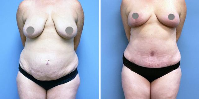 Mommy Makeover result at Bluemont Plastic Surgery in Fairfax, VA