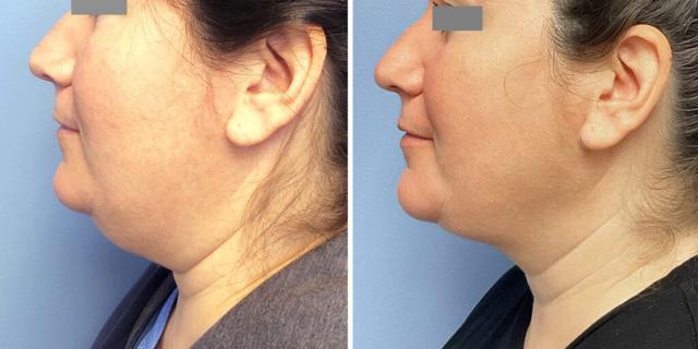 Facelift result at Bluemont Plastic Surgery in Fairfax, VA