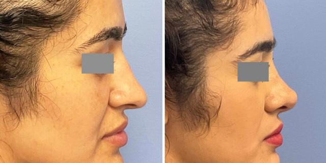 Rhinoplasty result at Bluemont Plastic Surgery in Fairfax, VA