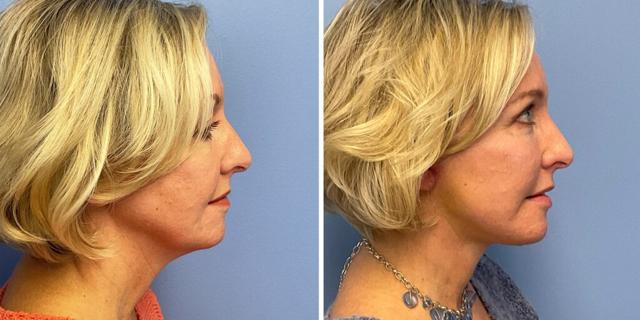 Facelift result at Bluemont Plastic Surgery in Fairfax, VA