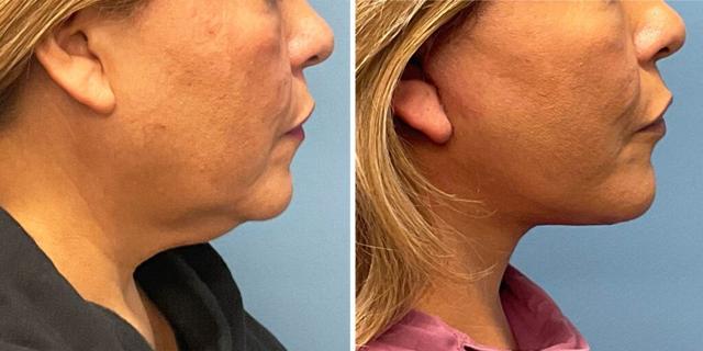 Facelift result at Bluemont Plastic Surgery in Fairfax, VA
