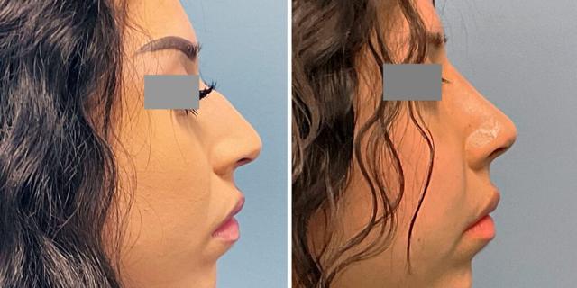Rhinoplasty result at Bluemont Plastic Surgery in Fairfax, VA