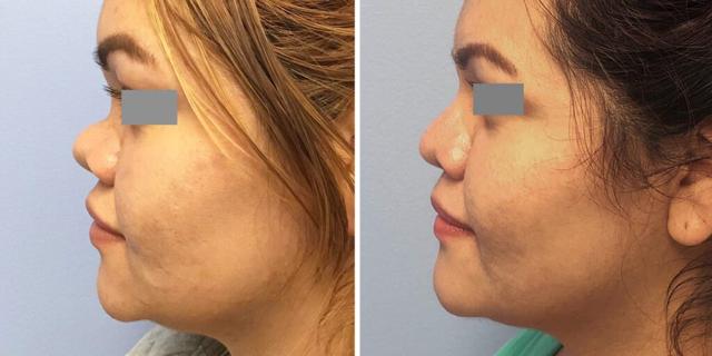 Rhinoplasty result at Bluemont Plastic Surgery in Fairfax, VA