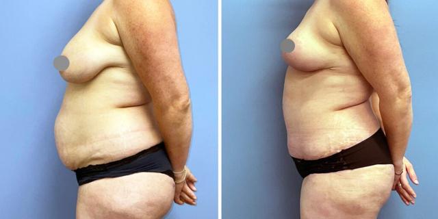 Mommy Makeover result at Bluemont Plastic Surgery in Fairfax, VA