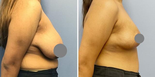 Breast Lift result at Bluemont Plastic Surgery in Fairfax, VA