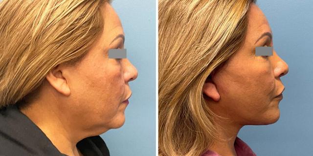 Facelift result at Bluemont Plastic Surgery in Fairfax, VA