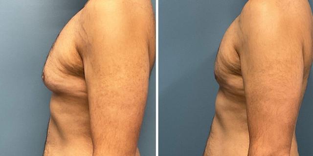 Gynecomastia Surgery result at Bluemont Plastic Surgery in Fairfax, VA