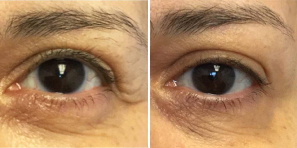 Bluemont Plastic Surgery result — Fairfax, VA