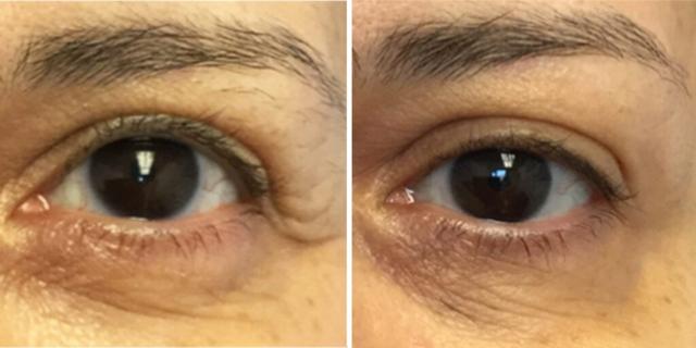 Blepharoplasty result at Bluemont Plastic Surgery in Fairfax, VA