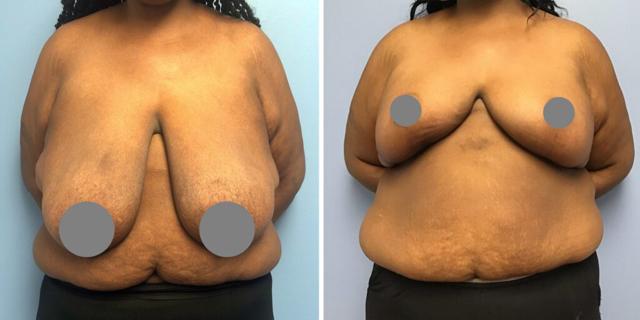 Breast Lift result at Bluemont Plastic Surgery in Fairfax, VA