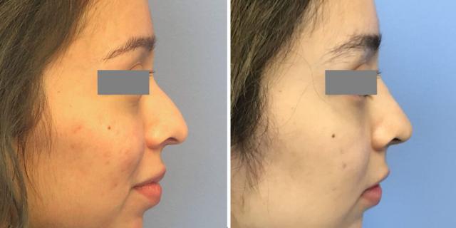 Rhinoplasty result at Bluemont Plastic Surgery in Fairfax, VA