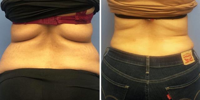 Liposuction result at Bluemont Plastic Surgery in Fairfax, VA