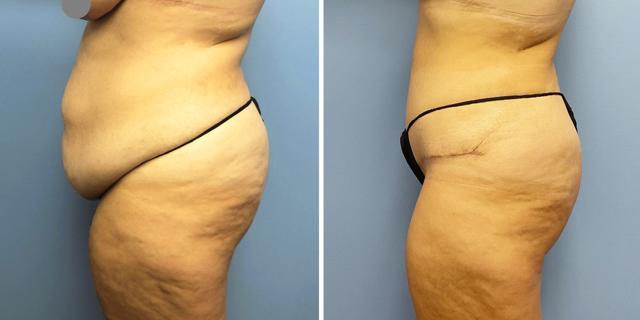 Tummy Tuck result at Bluemont Plastic Surgery in Fairfax, VA