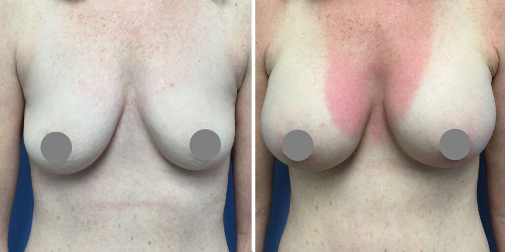 Bluemont Plastic Surgery breast augmentation result — Fairfax, VA