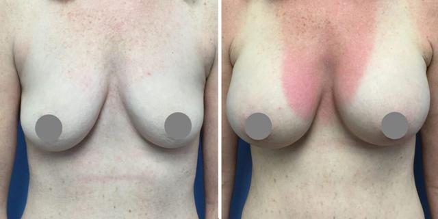 Breast Augmentation result at Bluemont Plastic Surgery in Fairfax, VA