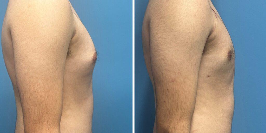 Bluemont Plastic Surgery result — Fairfax, VA