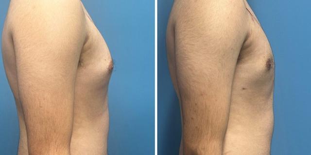 Gynecomastia Surgery result at Bluemont Plastic Surgery in Fairfax, VA