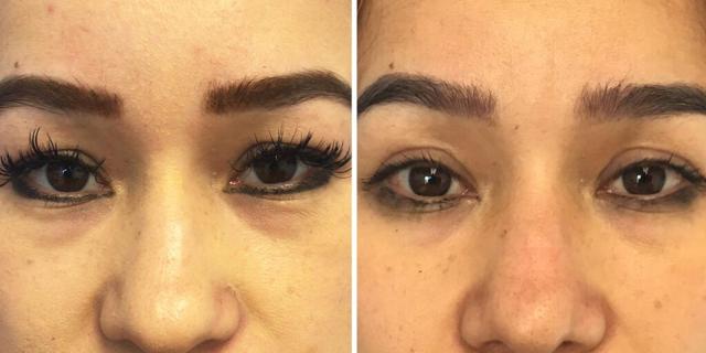 Blepharoplasty result at Bluemont Plastic Surgery in Fairfax, VA