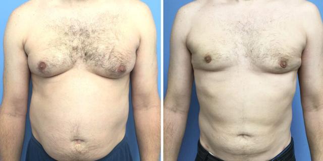 Gynecomastia Surgery result at Bluemont Plastic Surgery in Fairfax, VA