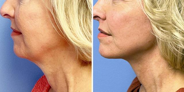 Facelift result at Bluemont Plastic Surgery in Fairfax, VA