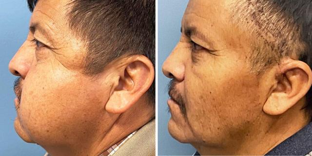 Facelift result at Bluemont Plastic Surgery in Fairfax, VA