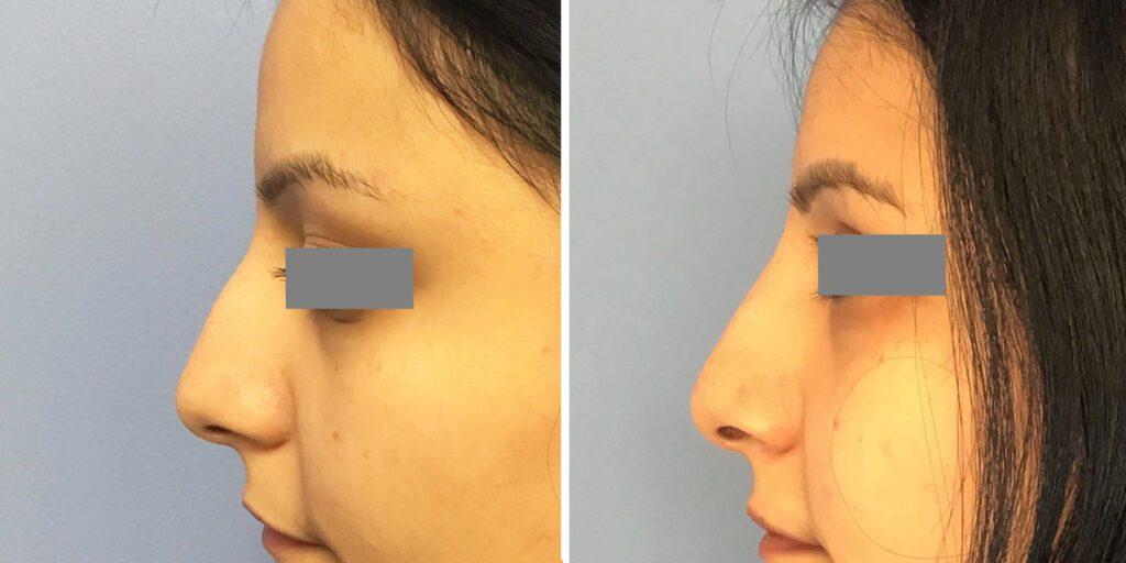 Bluemont Plastic Surgery result — Fairfax, VA