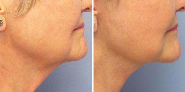 Neck Lift result at Bluemont Plastic Surgery in Fairfax, VA