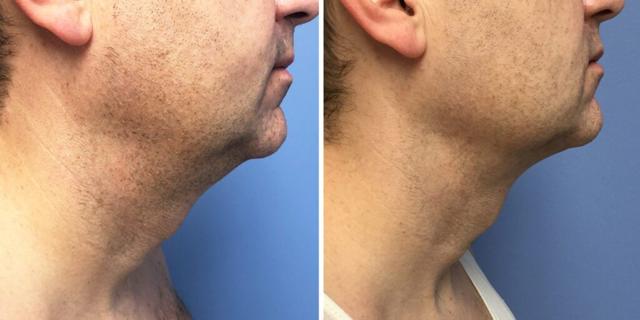 Facelift result at Bluemont Plastic Surgery in Fairfax, VA