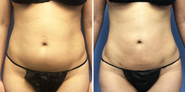 Liposuction result at Bluemont Plastic Surgery in Fairfax, VA