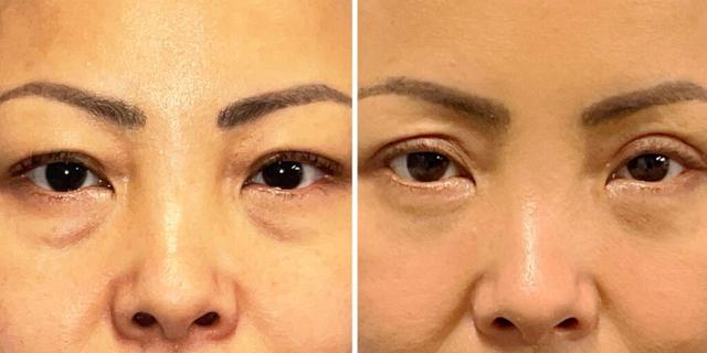 Blepharoplasty result at Bluemont Plastic Surgery in Fairfax, VA