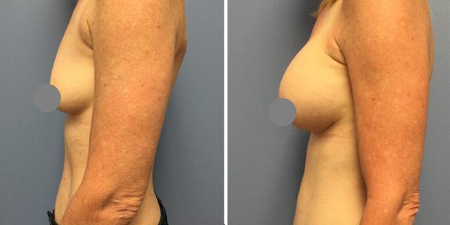 Breast Augmentation result at Bluemont Plastic Surgery in Fairfax, VA